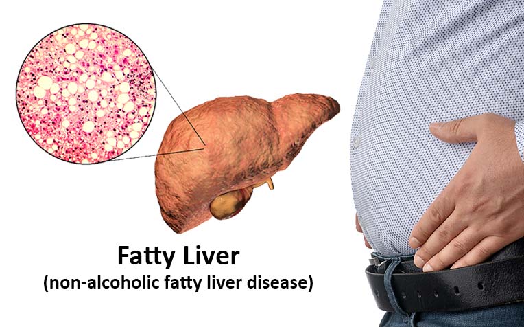 Five Strategies to Prevent Fatty Liver Disease