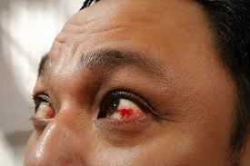 Diabetes and Vision: The Silent, Irreversible Threat You Can’t Afford to Ignore