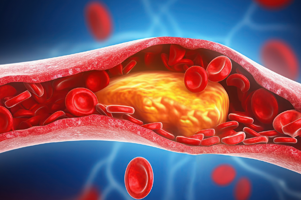 High Cholesterol: The Silent Threat and How to Spot the Warning Signs